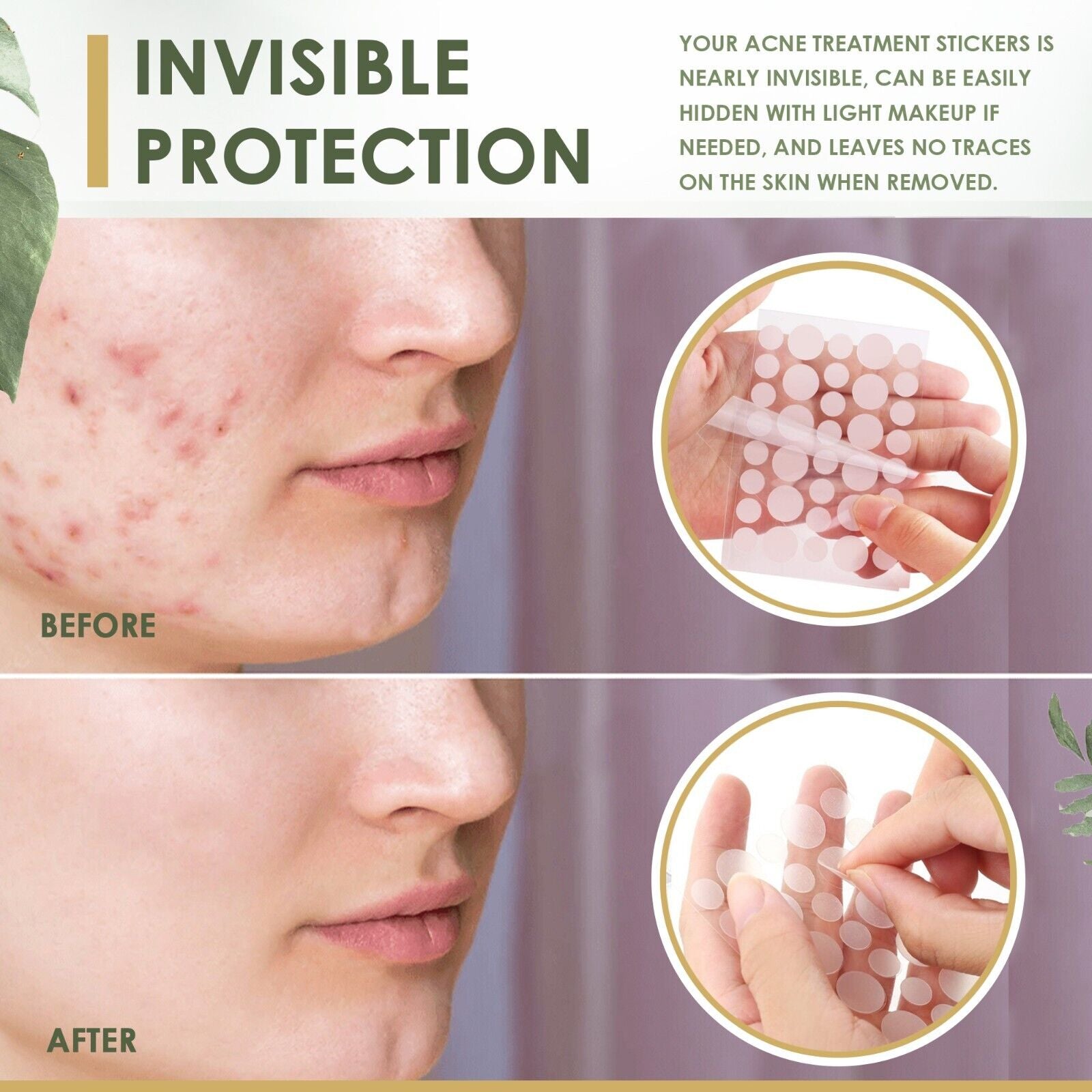 Acne Pimple Spot Zit Patches Hydrocolloid Invisible Acne Stickers Skin Treatment